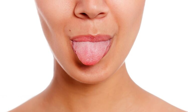 candida orale sintomi