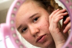 acne e candida