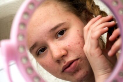 acne e candida